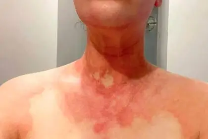 Scars all over Michelle Filippi’s body