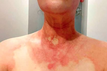PAINFUL REACTION: Michelle Fillipi says her painful skin condition is the result of foul emissions from Swanbank.