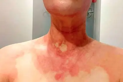 PAINFUL REACTION: Michelle Fillipi says her painful skin condition is the result of foul emissions from Swanbank.