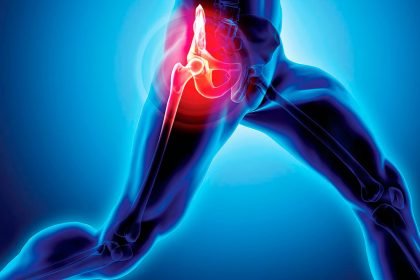 While genetics and age play a role, lifestyle choices can help delay or even prevent the need for hip surgery.