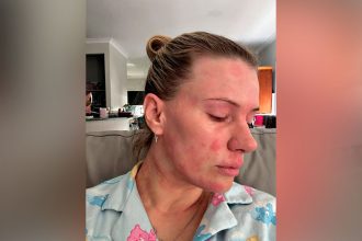 Michelle Fillipi says her scars highlight the health risks.