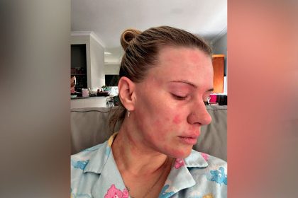 Michelle Fillipi says her scars highlight the health risks.