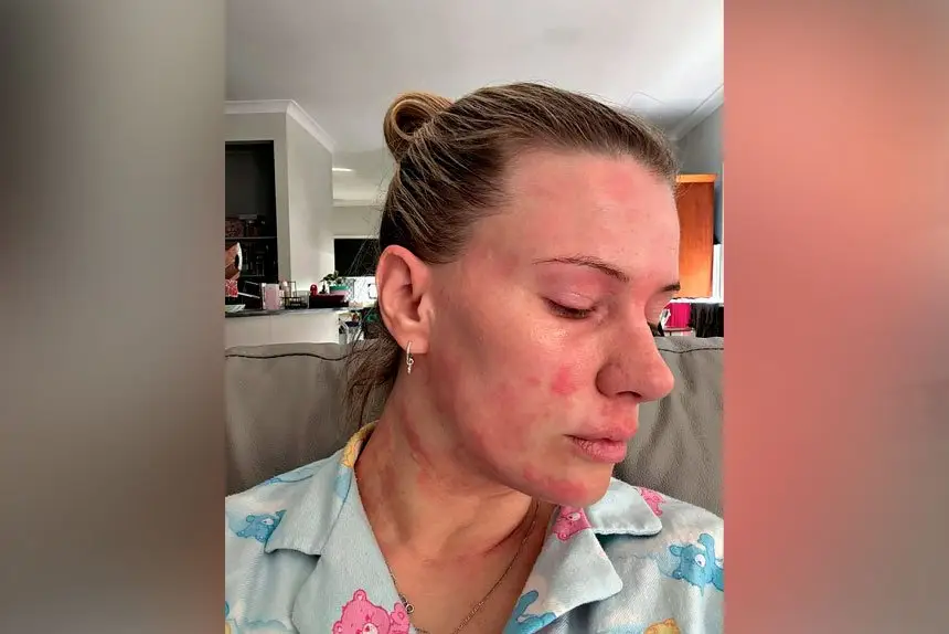 Michelle Fillipi says her scars highlight the health risks.